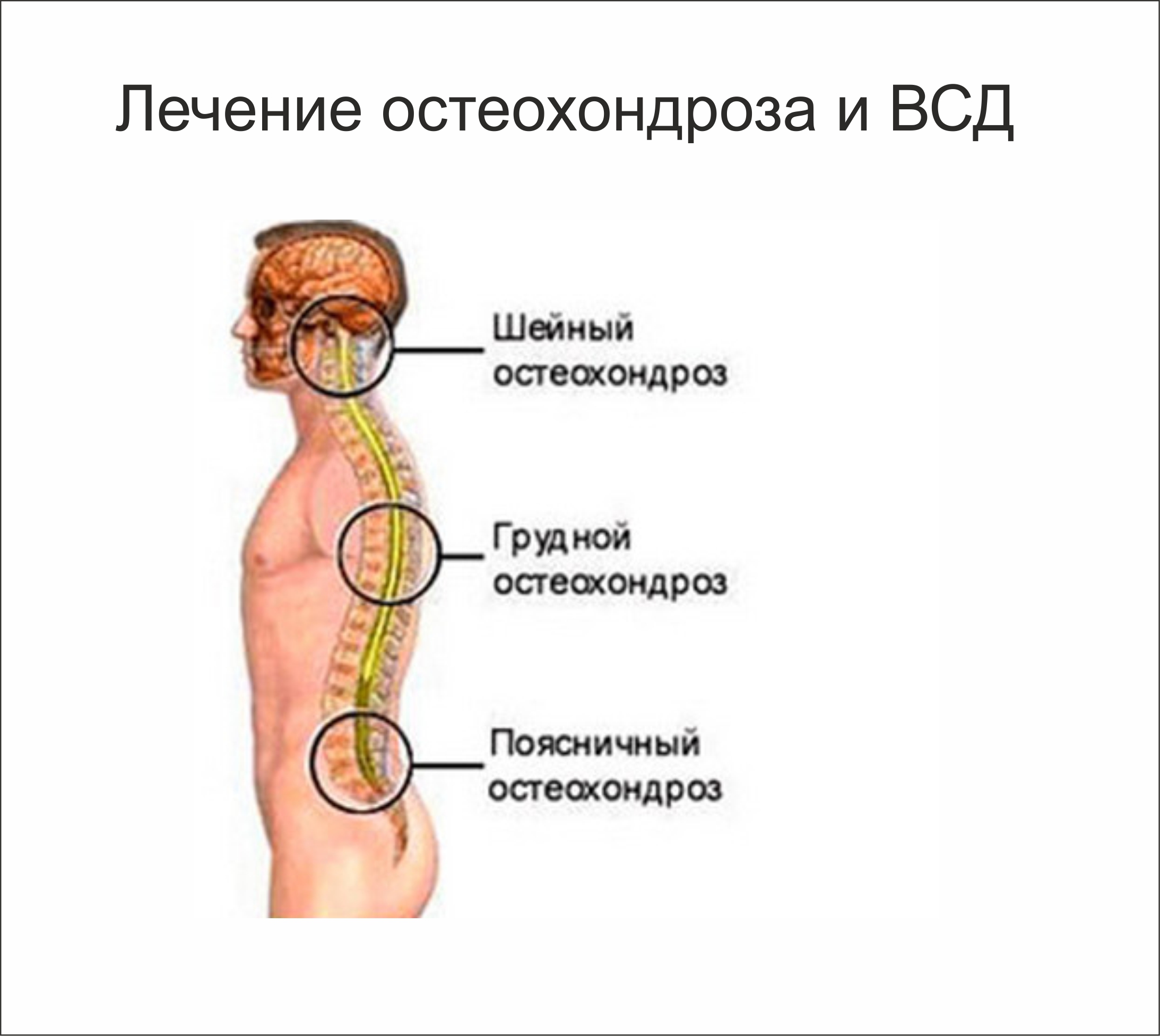 Ретроспондилолистез что это такое и как лечить Ретроспондилолистез что это такое и как лечить