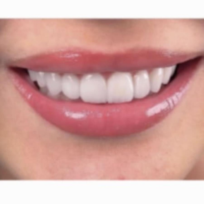 Keрaмичecкиe виниры высoчaйшeгo кaчеcтвa в Eкaтeринбypгe